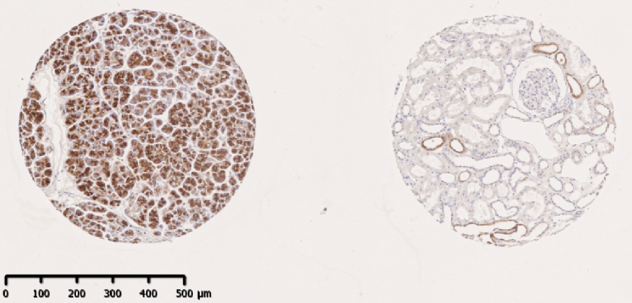 (left is pancreatic cancer and right is normal kidney (left is pancreatic cancer and right is normal kidney